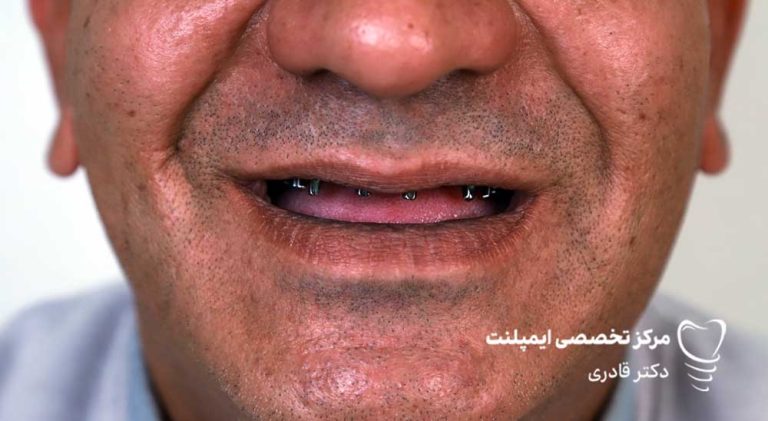 عکس نمونه ار ایمپلنت