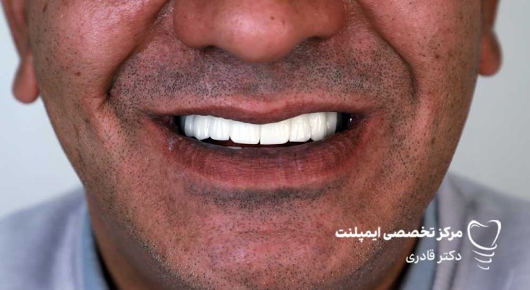 عکس نمونه ار ایمپلنت