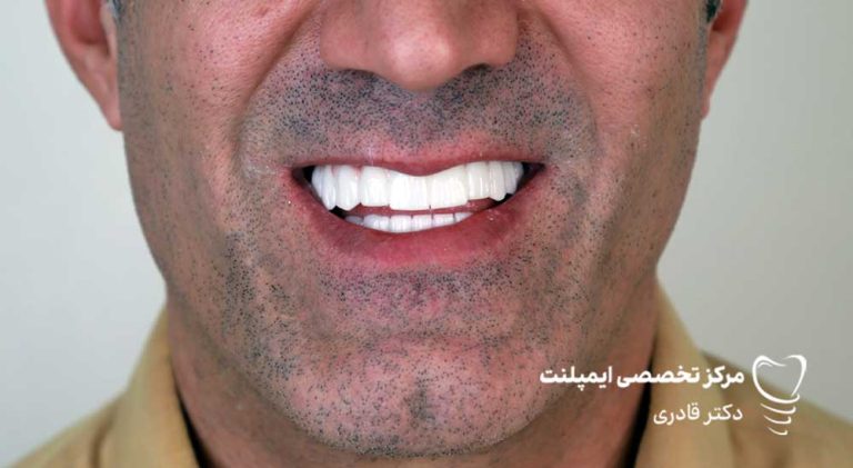 عکس نمونه ار ایمپلنت