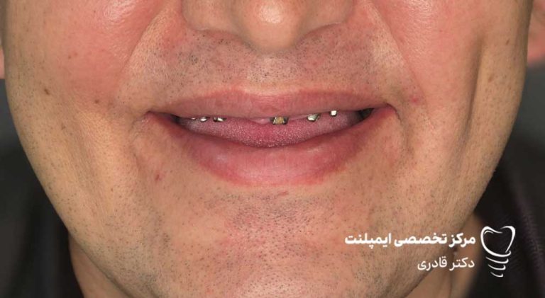 عکس-نمونه-کار-ایمپلنت5