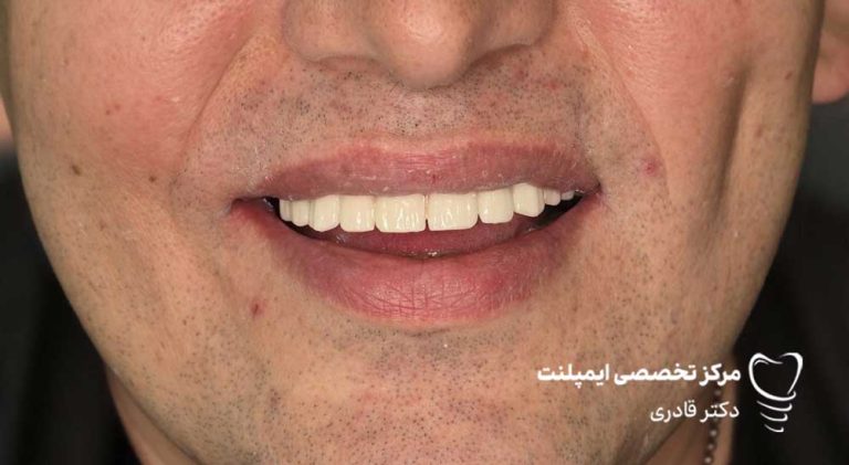 عکس نمونه ار ایمپلنت