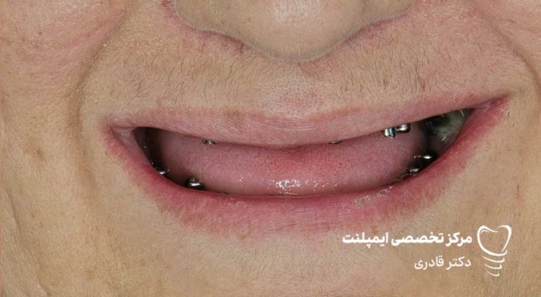 عکس نمونه ار ایمپلنت