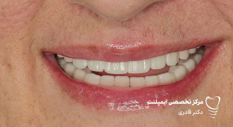 عکس نمونه ار ایمپلنت