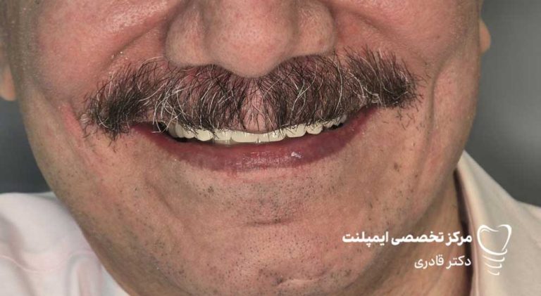 عکس نمونه ار ایمپلنت