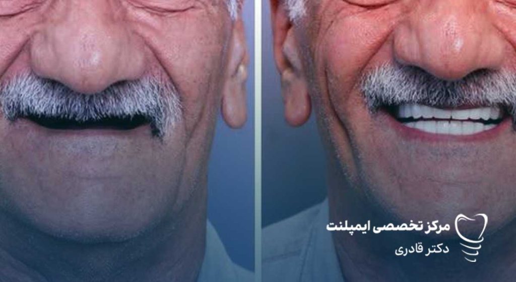 عکس ایمپلنت دندان قبل و بعد