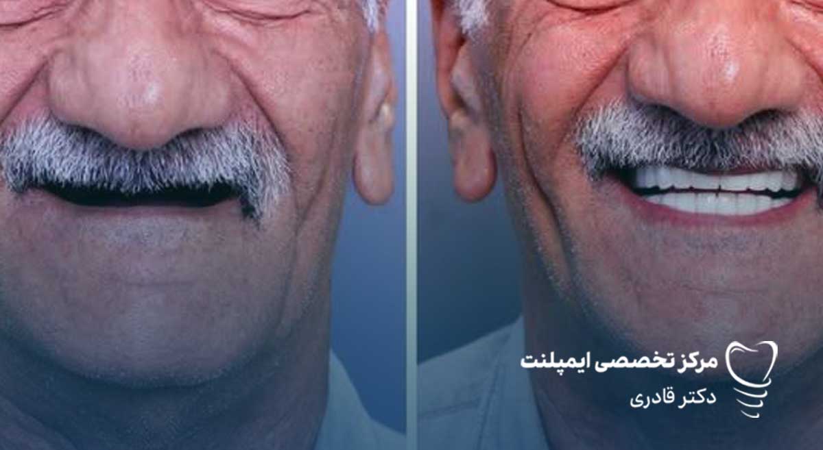 عکس ایمپلنت دندان قبل و بعد نمونه کار ایمپلنت - نمونه درمان