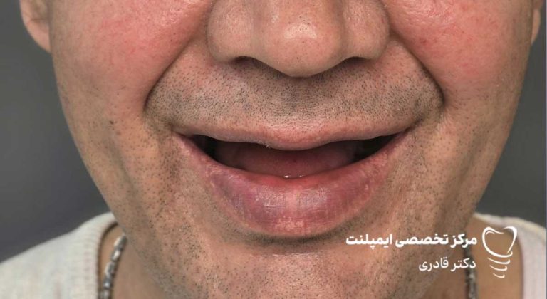 عکس نمونه کار ایمپلنت