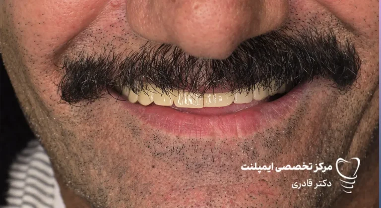 عکس نمونه کار ایمپلنت