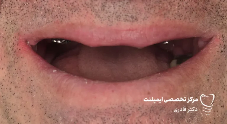 عکس نمونه کار ایمپلنت