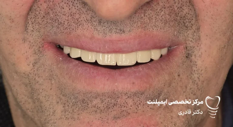 عکس نمونه کار ایمپلنت