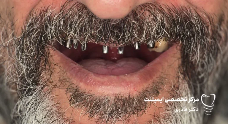 عکس نمونه کار ایمپلنت