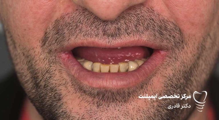 عکس و فیلم ایمپلنت قبل و بعد