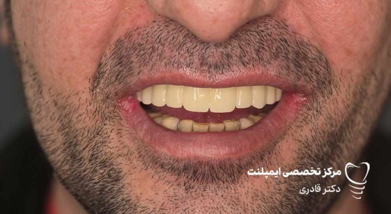 عکس و فیلم ایمپلنت قبل و بعد