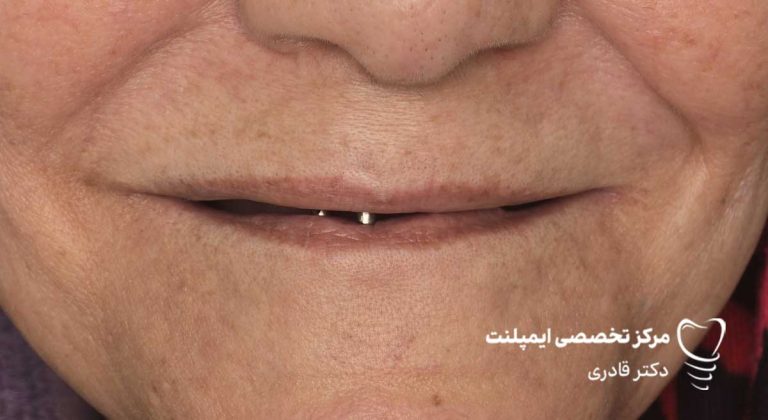 عکس و فیلم ایمپلنت قبل و بعد