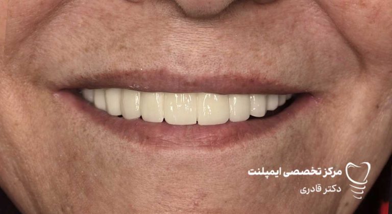 عکس و فیلم ایمپلنت قبل و بعد