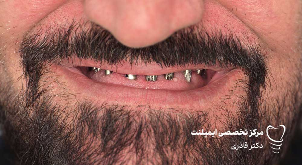 نمونه عکس ایمپلنت قبل و بعد