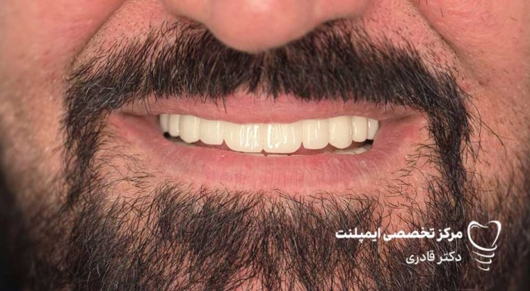 نمونه عکس ایمپلنت قبل و بعد