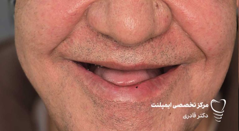 نمونه عکس ایمپلنت قبل و بعد