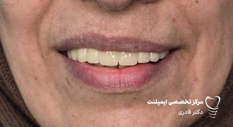 نمونه عکس ایمپلنت قبل و بعد