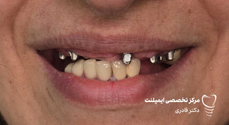 نمونه عکس ایمپلنت قبل و بعد