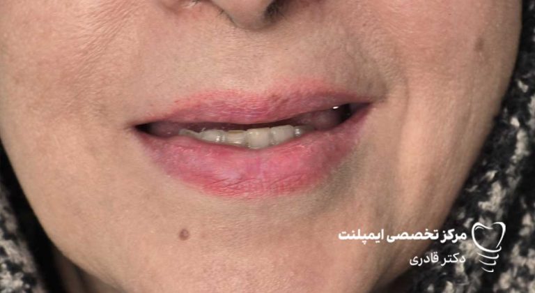 نمونه عکس ایمپلنت قبل و بعد