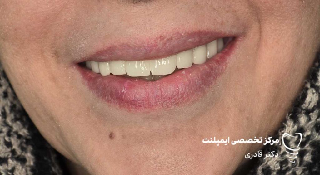 نمونه عکس ایمپلنت قبل و بعد