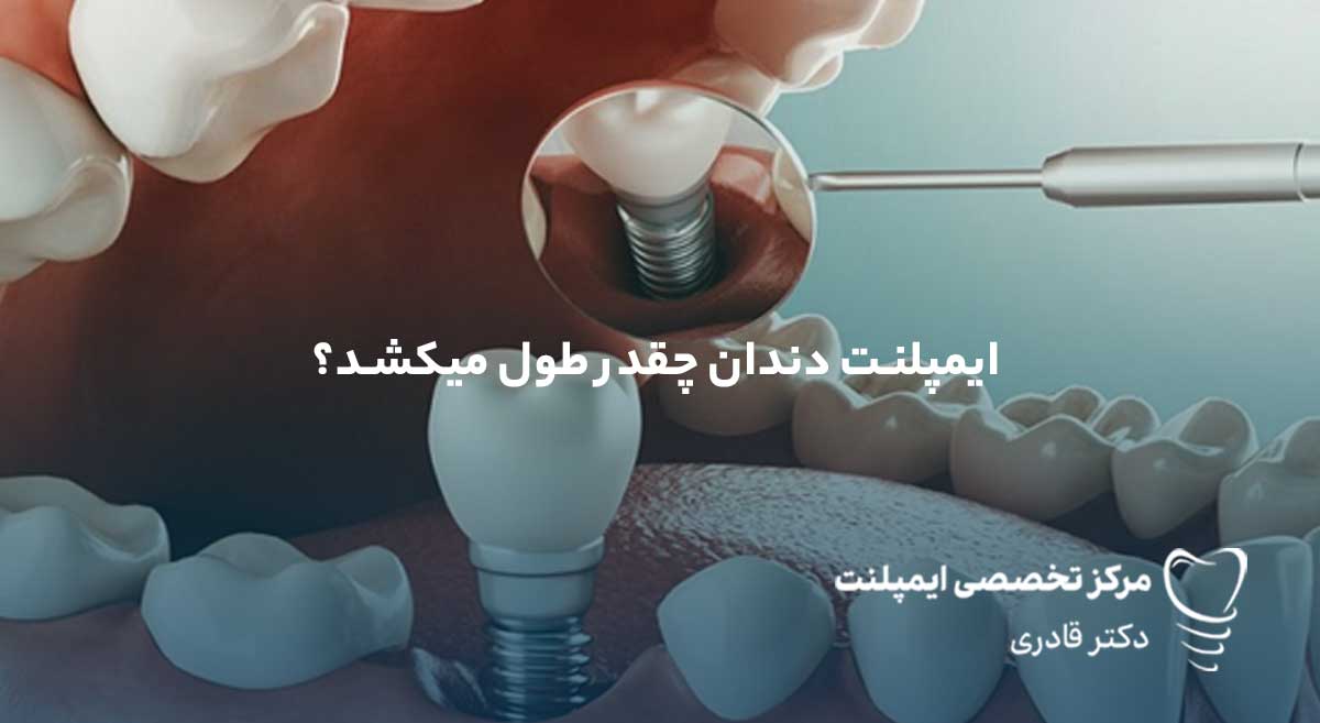 ایمپلنت چقدر طول میکشد