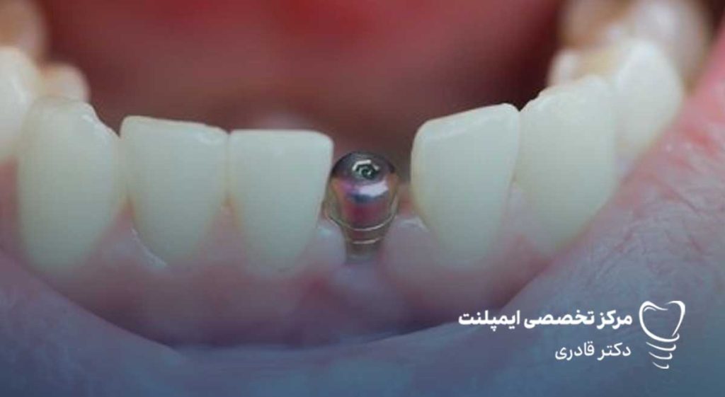 ایمپلنت دندان چقدر طول میکشد