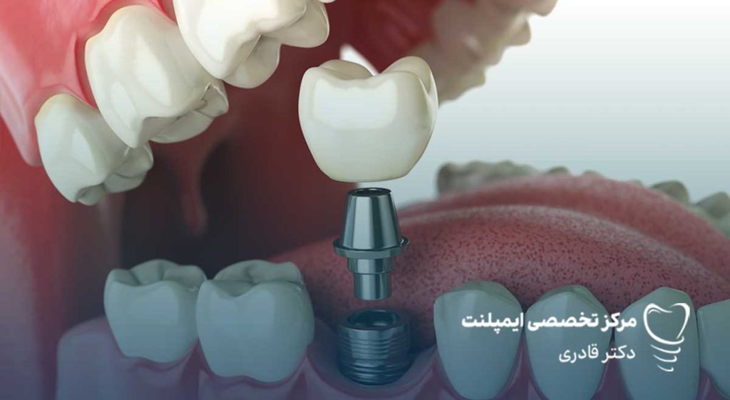ایمپلنت دندان چقدر طول میکشد