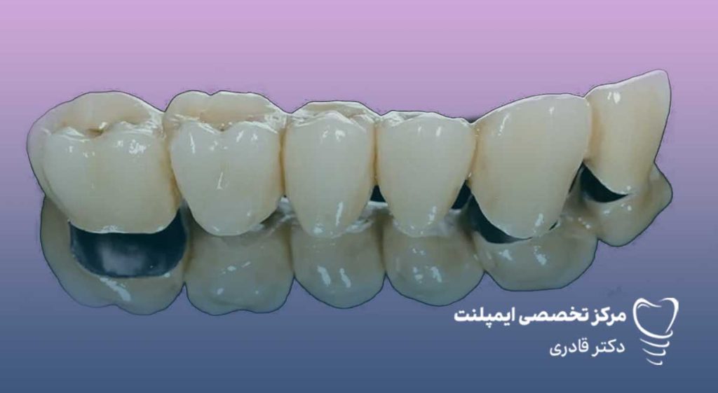 قیمت انواع روکش