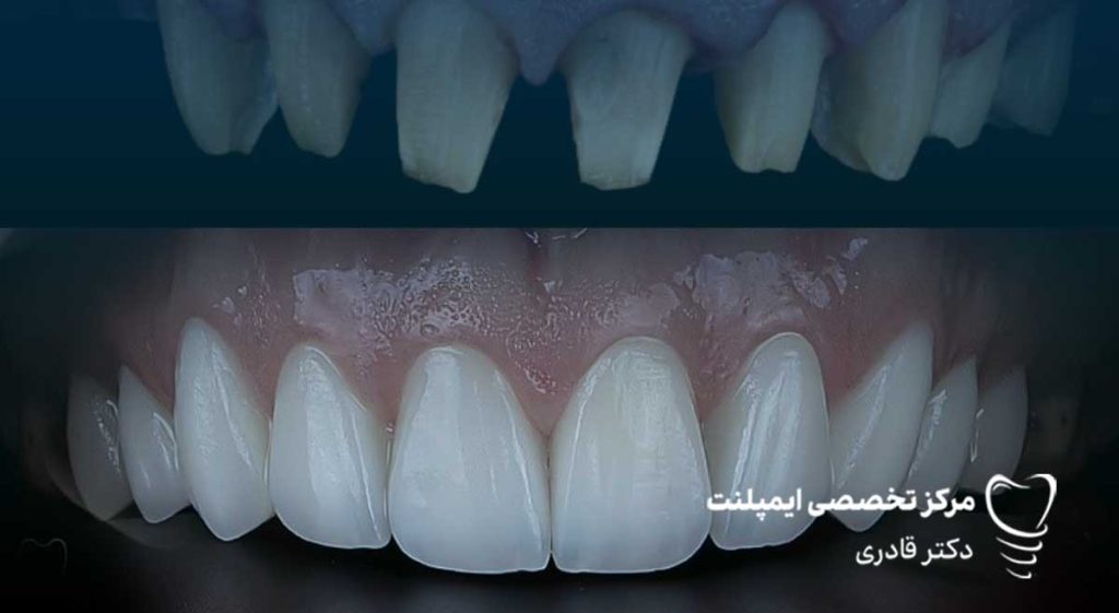 قیمت روکش دندان سرامیکی