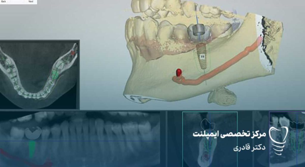 مزیت قالبگیری دیجیتال1