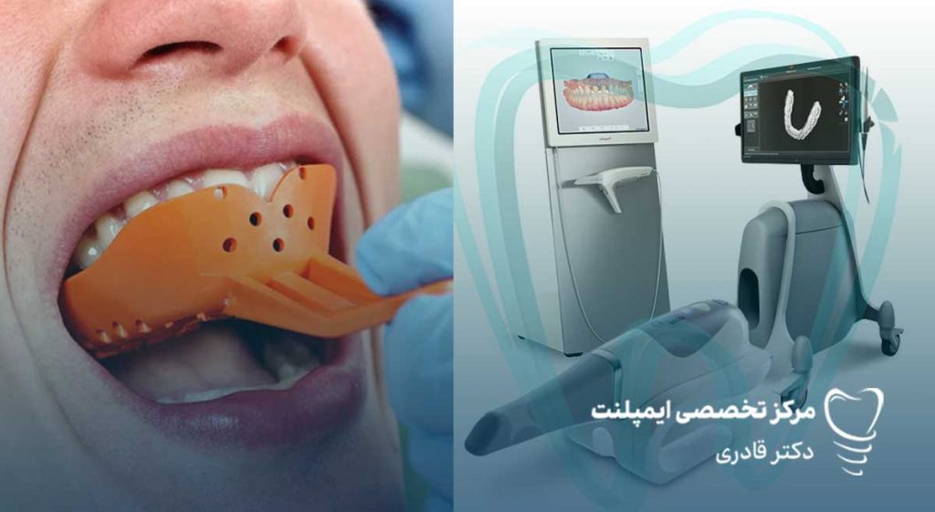 مزیت قالبگیری دیجیتال3