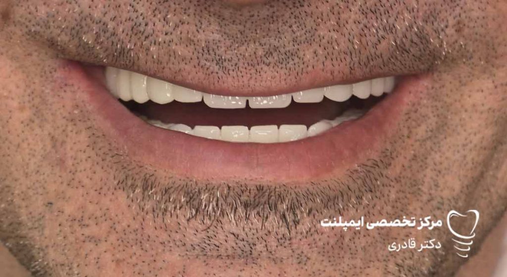 عکس ایمپلنت نمونه کار جدید