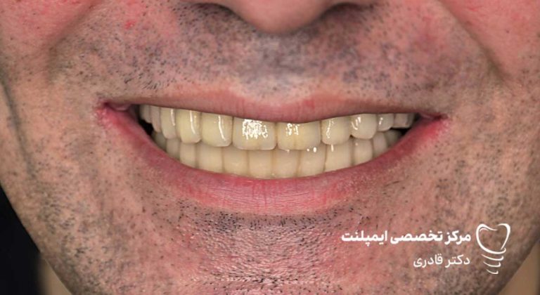 عکس ایمپلنت نمونه کار جدید