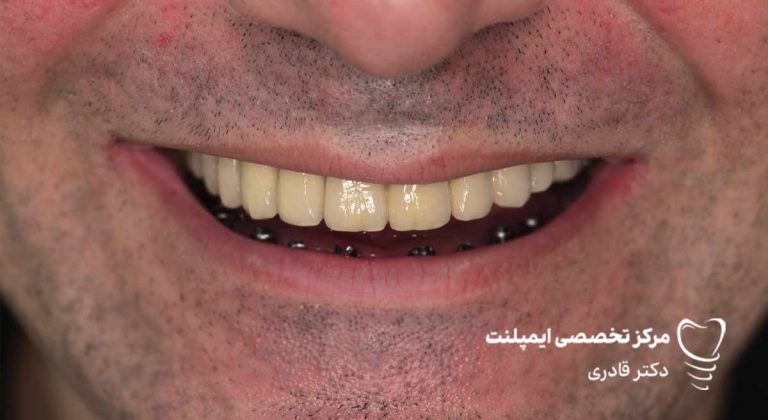 عکس ایمپلنت نمونه کار جدید