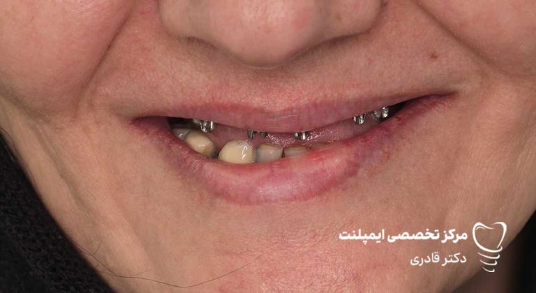 عکس ایمپلنت نمونه کار جدید