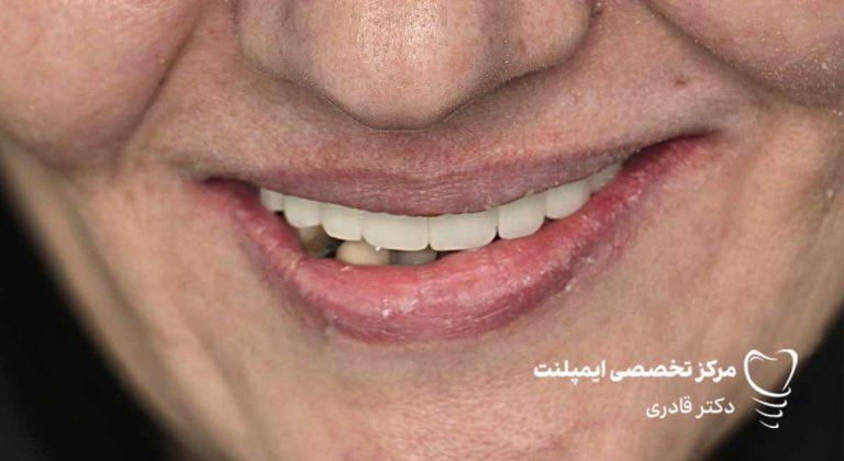 عکس ایمپلنت نمونه کار جدید
