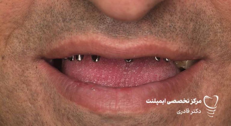 عکس ایمپلنت نمونه کار جدید