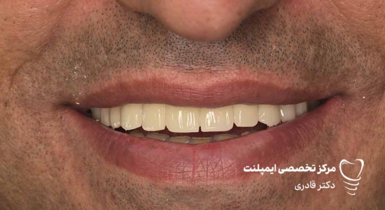 عکس ایمپلنت نمونه کار جدید