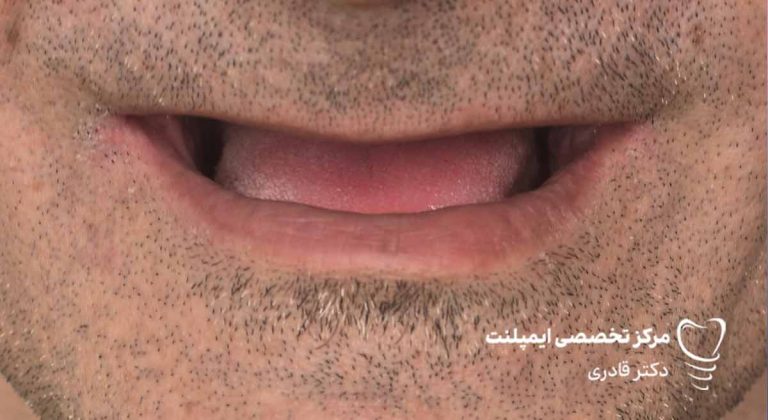 عکس ایمپلنت نمونه کار جدید