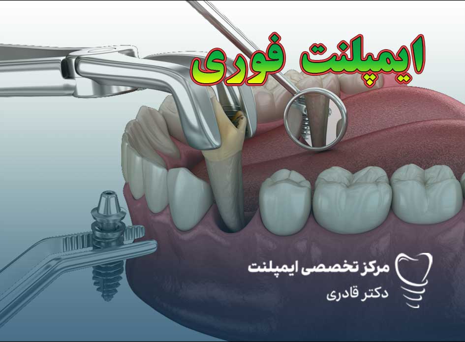 ایمپلنت فوری چیست