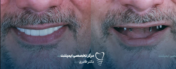 ایمپلنت فوری چیست