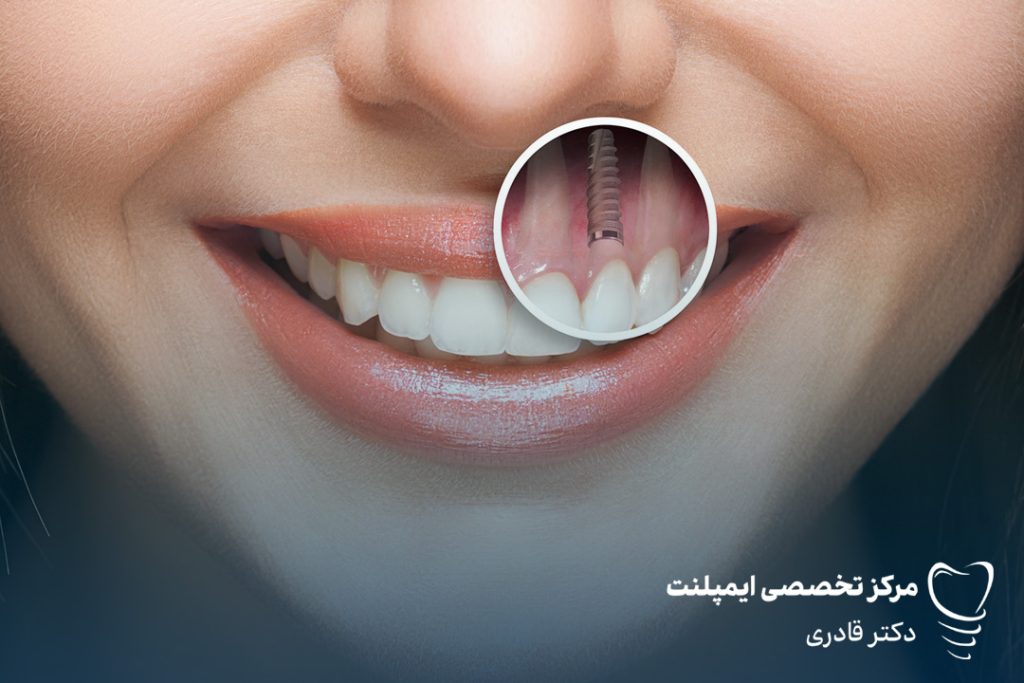 ایمپلنت فوری پس زده می شود