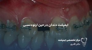 ایمپلنت دندان در حین ارتودنسی
