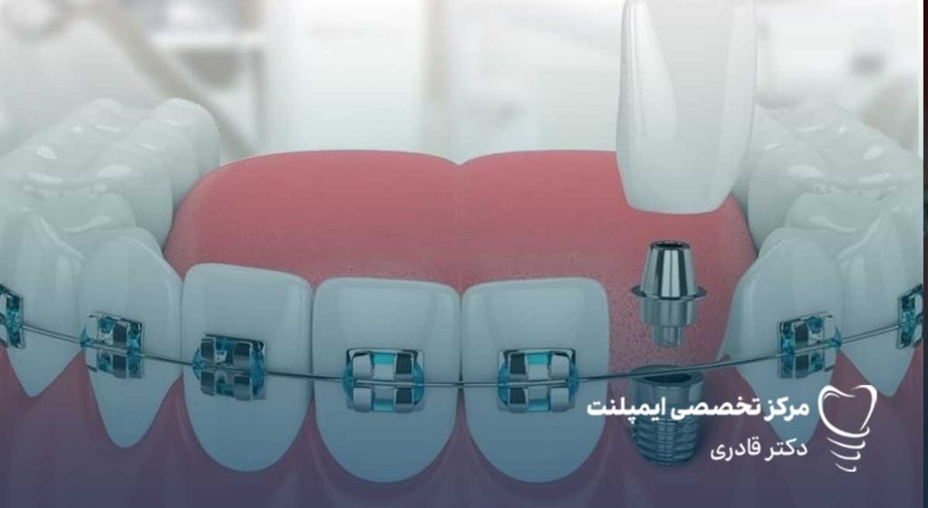 ایمپلنت دندان در ارتودنسی