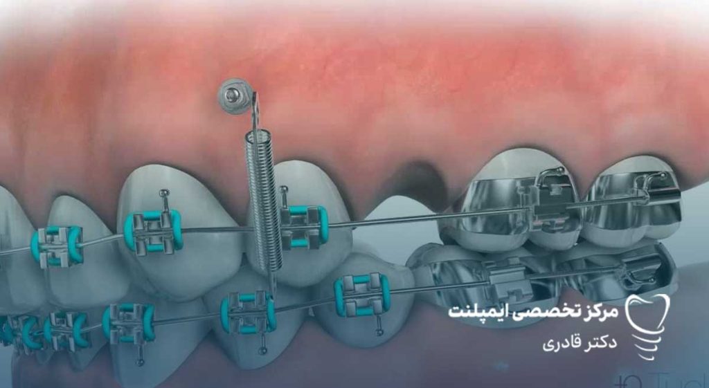 کاشت ایمپلنت دندان در حین درملن ارتودنسی