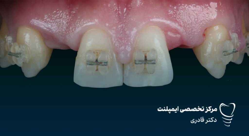 پرکردن جای خالی دندان در ارتودنسی