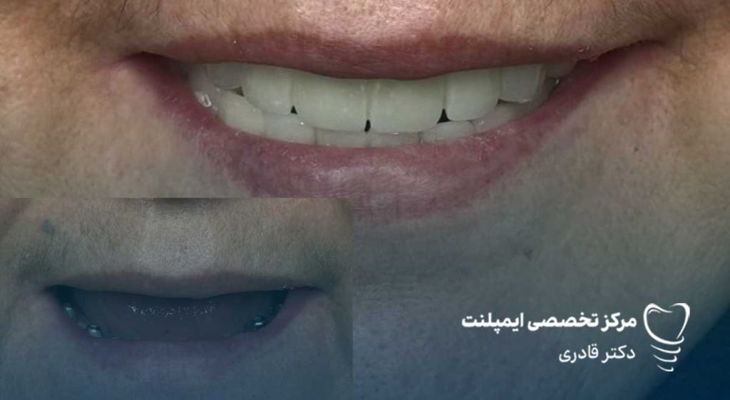 قیمت ایمپلنت کره ای 1404 (هزینه و لیست برند ها ) شرایط اقساط و ضمانت 2 نمونه عکس قبل و بعد ایمپلنت دندان کره ای