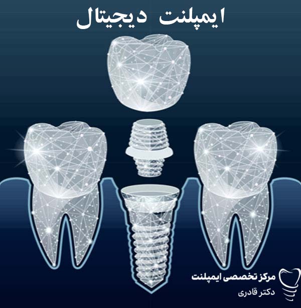 ایمپلنت دیجیتال چیست